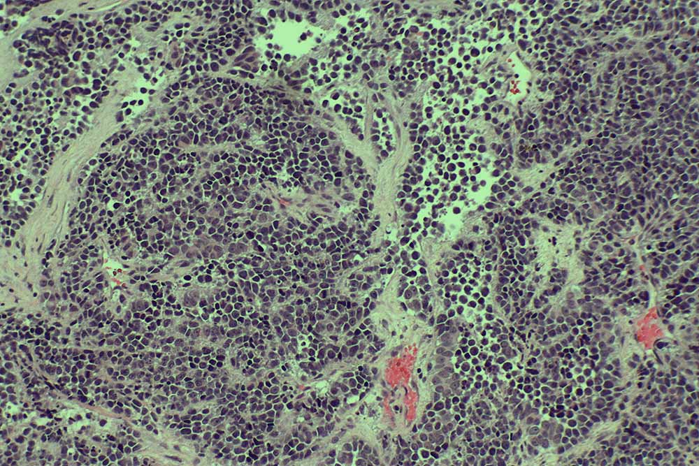 appearance-of-small-cell-cancer